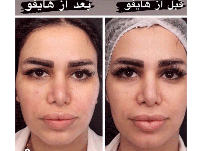 فیشیال و پاک سازی پوست آنیتا صابر در مشهد